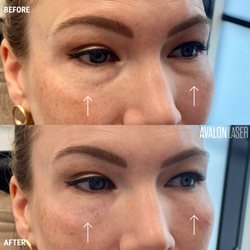 Avalon Laser - Client received .5 syringe of Restylane Kysse as under-eye filler. (Side View)
