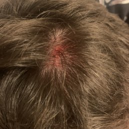 My injury to the back left side of my head. My injury to the back left side of my head.