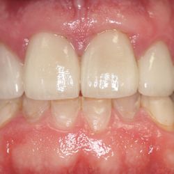 Dentistry at Maricopa - Porcelain crowns and veneers on the top front 8 teeth due to severe wear. Beautiful natural result by Dr Daniel Gibbons.