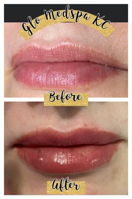 Lip enhancement aka lip filler - Lip enhancement is so fun and has instant results! 👄 Book your appointment today for your free consultation.🙌 Lip enhancement aka lip filler - Lip enhancement is so fun and has instant results! 👄 Book your appointment today for your free consultation.🙌