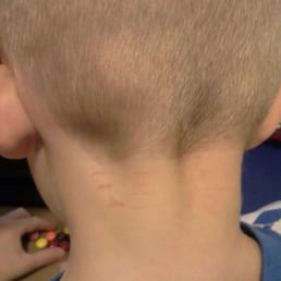 Edge Production Barbershop knicked up my son's neck. The photo is a day old, and not quite as red as the day of the cut. Edge Production Barbershop knicked up my son's neck. The photo is a day old, and not quite as red as the day of the cut.