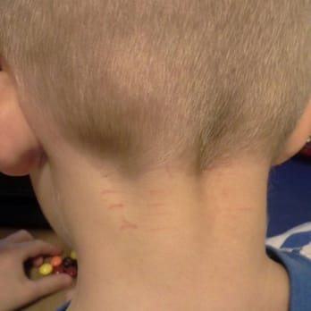 EdgePro Barbershop - Edge Production Barbershop knicked up my son's neck. The photo is a day old, and not quite as red as the day of the cut. - Barbers Near Me - Austin, Texas EdgePro Barbershop - Edge Production Barbershop knicked up my son's neck. The photo is a day old, and not quite as red as the day of the cut. - Barbers Near Me - Austin, Texas