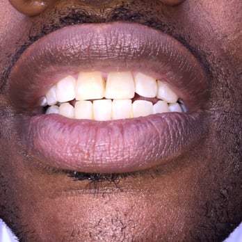 The Whitening Bar - Come enhance your smile today. - Cosmetic Dentists Near Me - Suwanee, Georgia The Whitening Bar - Come enhance your smile today. - Cosmetic Dentists Near Me - Suwanee, Georgia