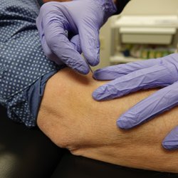 Cornell Physical Therapy - Dry needling for "tennis elbow"
