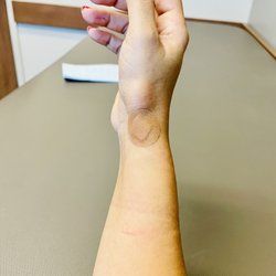 Proliance Orthopaedics & Sports Medicine - Post injection for over using my hand! Glad I Ubered!