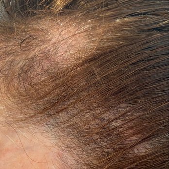 Albert W Chow, MD - Present - 5 months after transplants. Looks worse when not combed. - Cosmetic Surgeons Near Me - San Francisco, California