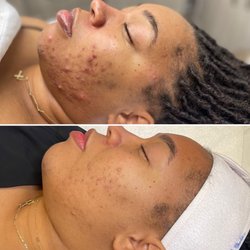 Skyn Haven Aesthetics - Acne Treatments