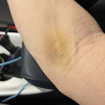 Parexel Los Angeles - These pics don't do the color of the bruises justice - Psychiatrists Near Me - Glendale, California Parexel Los Angeles - These pics don't do the color of the bruises justice - Psychiatrists Near Me - Glendale, California