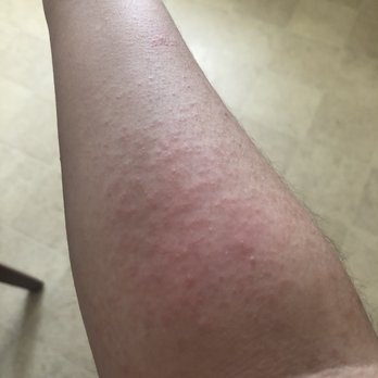 Perfect Nails - Of my left arms rash soon after leaving their salon - Waxing Near Me - Cumberland, Rhode Island