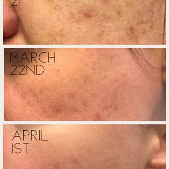 Complete Dermatology - After receiving just one IPL photo facial treatment at Complete Dermatology my face looks so much better! - Dermatologists Near Me - Sugar Land, Texas
