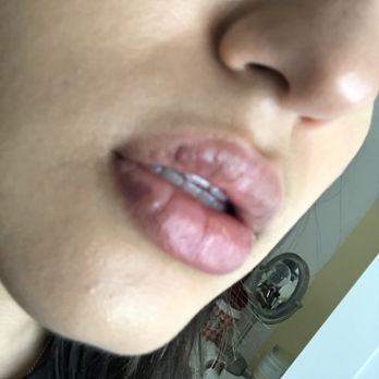 D & E Aesthetics - 2 weeks after injection - Day Spas Near Me - San Jose, California