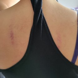 Happy Feet Relax Center - The mark of a professional massage: bruises still apparent two days later.