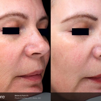 Midwest Laser Center - Tattoo Removal Near Me - Chesterfield, Missouri Midwest Laser Center - Tattoo Removal Near Me - Chesterfield, Missouri