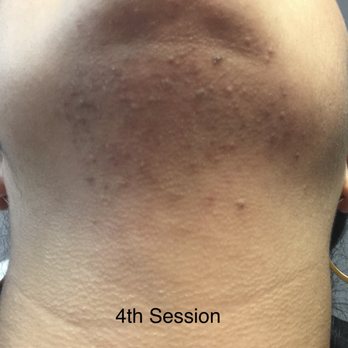 Laser Remedy MedSpa - 4th Session - Laser Hair Removal Near Me - Philadelphia, Pennsylvania Laser Remedy MedSpa - 4th Session - Laser Hair Removal Near Me - Philadelphia, Pennsylvania