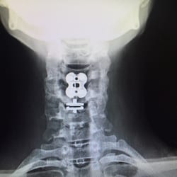 Luna Spine and Orthopaedic Surgery - Fused in 77 days c4/5 Dr. Luna did my fusion c4/5 above the c5/6 disk replacement on 4-1-16! Thank You Dr Luna! Joy