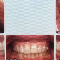 Alexander & Hoffman Orthodontics - Choppers
