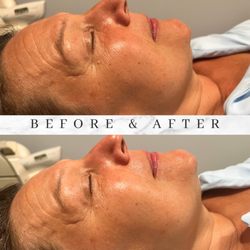 Hamsa Holistics - Before and after a hydro glow trifecta!