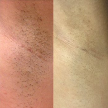 LaserAway - Left: 2 weeks of no shaving. Right: after 7(?) sessions and 2 weeks of no shaving! - Medical Spas Near Me - Dublin, California LaserAway - Left: 2 weeks of no shaving. Right: after 7(?) sessions and 2 weeks of no shaving! - Medical Spas Near Me - Dublin, California