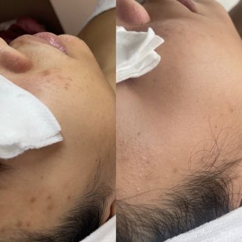 Authentic Skin - Results after one treatment. - Estheticians Near Me - Chicago, Illinois Authentic Skin - Results after one treatment. - Estheticians Near Me - Chicago, Illinois