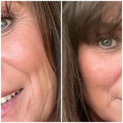 Body Medspa of Oakbrook - Left is before Vampire facial & Botox and the right is 10 days after full healing