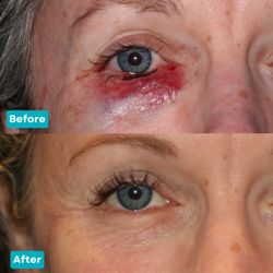 Michael Burnstine, MD - Pasadena Oculoplastic Surgeon - This patient underwent an eyelid reconstruction after the removal of a basal cell carcinoma