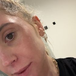 Sonya Dakar Skin Clinic - After