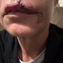 Epiphany Dermatology - Day 3 after MOHS surgery.