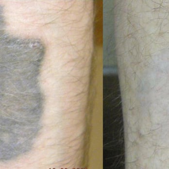 Blink Tattoo Removal - Tattoo Removal Near Me - Seattle, Washington