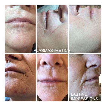 Lasting Impressions By Diane - If you have a special event soon! Tighten those wrinkles in one visit at Lasting Impressions❤️ - Permanent Makeup Near Me - Silverdale, Washington Lasting Impressions By Diane - If you have a special event soon! Tighten those wrinkles in one visit at Lasting Impressions❤️ - Permanent Makeup Near Me - Silverdale, Washington