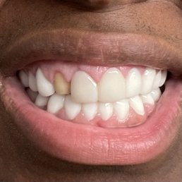 In only 3 days, my tooth has come off. In only 3 days, my tooth has come off.