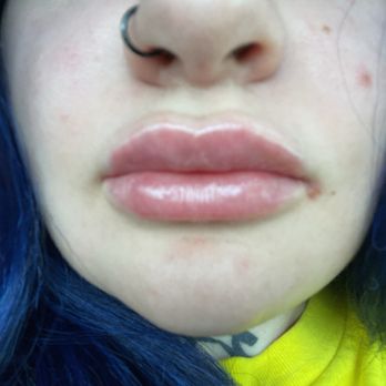 Kiss Aesthetics - Medical Spas Near Me - Minooka, Illinois Kiss Aesthetics - Medical Spas Near Me - Minooka, Illinois