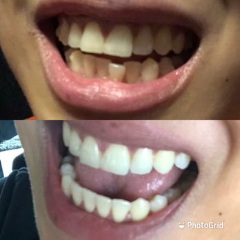 ConfiDental Smile - Before and after Invisalign - General Dentistry Near Me - San Francisco, California ConfiDental Smile - Before and after Invisalign - General Dentistry Near Me - San Francisco, California
