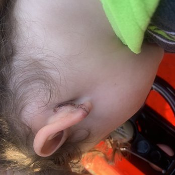 Baptist Clay Medical Campus - His ear after they glued his ear back on - Medical Centers Near Me - Fleming Island, Florida