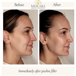 Meraki Medical Aesthetics - My 1st time getting jawline filler.