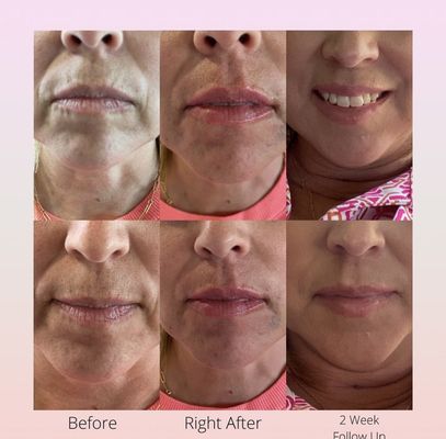 Botox & Fillers - Botox and Fillers done in the privacy and comfort of your own home. Botox & Fillers - Botox and Fillers done in the privacy and comfort of your own home.