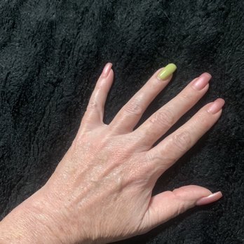 Luxe - After my second treatment. I'm so happy!! I no longer have my moms hands!! - Medical Spas Near Me - Alamogordo, New Mexico