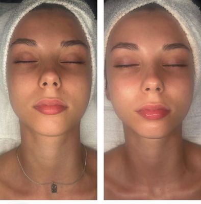 Corrective Acne Treatment - Acne treatments are suitable for anyone dealing with acne, from teenagers to adults! We will assess your skin, create a plan, and work to help you achieve and maintain clear skin! Corrective Acne Treatment - Acne treatments are suitable for anyone dealing with acne, from teenagers to adults! We will assess your skin, create a plan, and work to help you achieve and maintain clear skin!