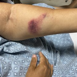 American Medical Response-Western Region - Bruise arm from collapsed IV