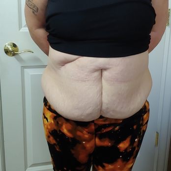 Elite MD - Before Lipo - Cosmetic Surgeons Near Me - Danville, California Elite MD - Before Lipo - Cosmetic Surgeons Near Me - Danville, California