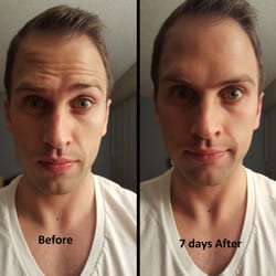 Before and after 40 units of Botox treatment.