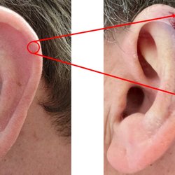 Morris R Denis T, MD - DR. Morris's solution to removing a small CNH. Normal procedure leaves the ear fully intact.