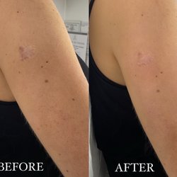La Jolla Skin Studio - Before and after ONE treatment with Faith