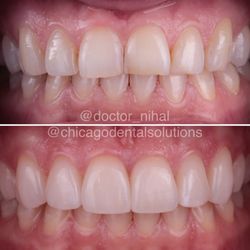 Chicago Dental Solutions - Lincoln Dental Care - Six Upper Porcelain Veneers
