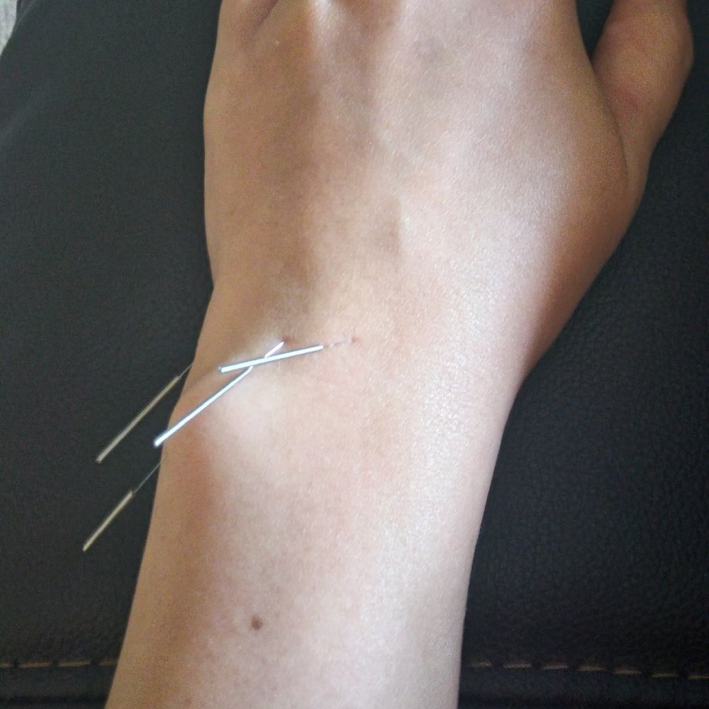 Syntruvia - My first acupuncture ever with Dr. Cris. - Acupuncture Near Me - San Diego, California