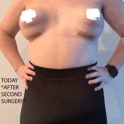 Michael A Fiorillo, MD - Reflections Medical - Today - after second surgery. Double bubble