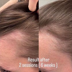SkinPro Glam - Hair regrowth stimulation