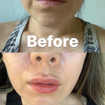 Indulge - Before & After picture of Fillers done to my Nasolabial folds and Lips! - Eyelash Service Near Me - Aiea, Hawaii Indulge - Before & After picture of Fillers done to my Nasolabial folds and Lips! - Eyelash Service Near Me - Aiea, Hawaii