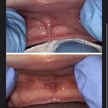 Elena Rumack, DDS MS - Before and after Lip tie laser revision - Pediatric Dentists Near Me - Calabasas, California
