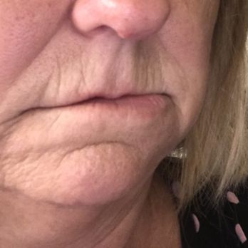 Murrieta Dental Group - I was in this type of shape and still with all kinds of infection and Dr. Tran thought it was a good idea to put the permanent? - Cosmetic Dentists Near Me - Murrieta, California Murrieta Dental Group - I was in this type of shape and still with all kinds of infection and Dr. Tran thought it was a good idea to put the permanent? - Cosmetic Dentists Near Me - Murrieta, California