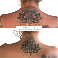 Harmony Aesthetics Center - Trap Tox